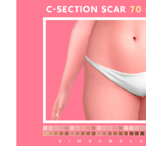 C-Section #2